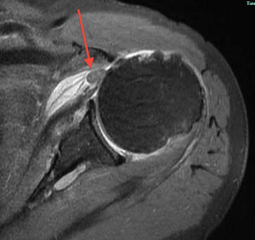 Medially Dislocated Biceps Tendon with Torn Subscapularis